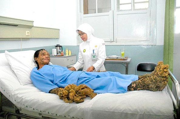 Seorang perawat memeriksa Dede (38) pasien penyakit kulit yang dikenal sebagai manusia pohon,  di Ruang Bougenville, RS Hasan Sadikin, Bandung. Minggu (25/11).